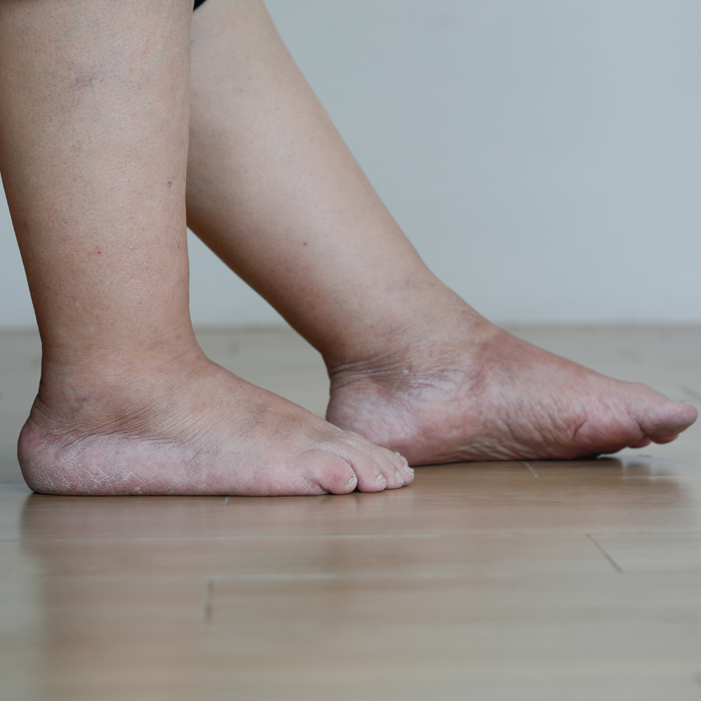 Jambes gonflées : causes, solutions et prévention de l'œdème des jambes ...