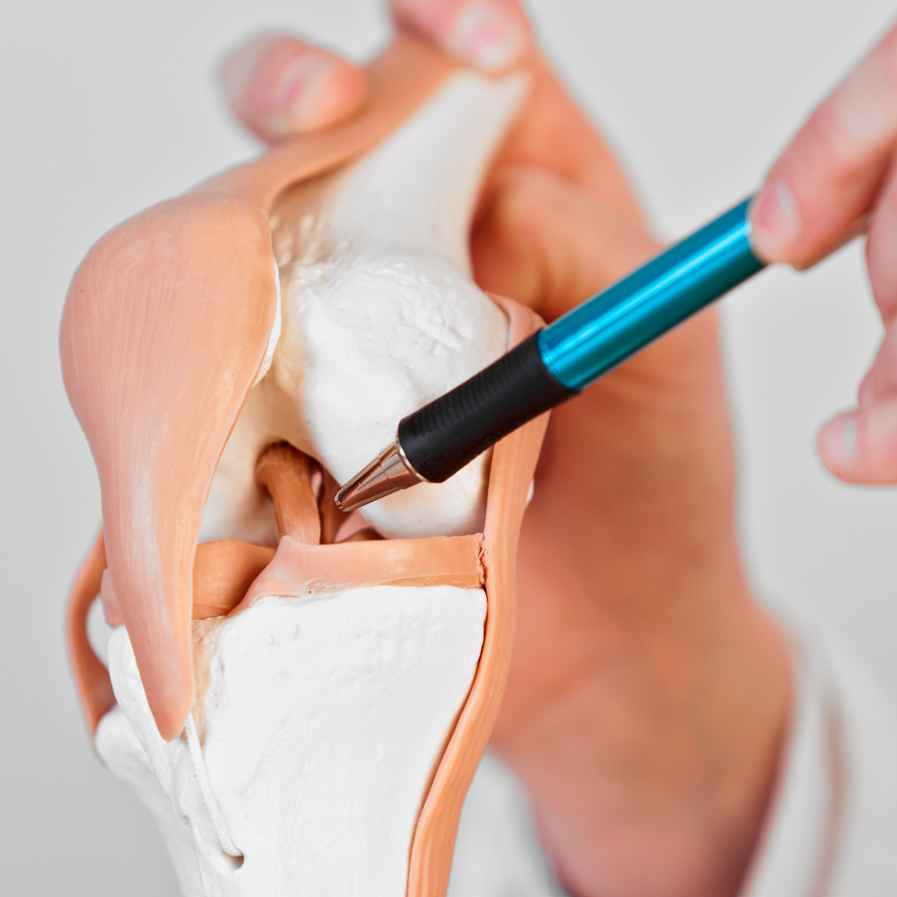 Rupture des ligaments croisés du genou : Guide complet et conseils pratiques