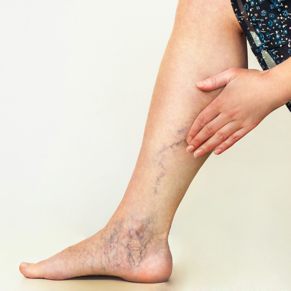 Varices : Définitions, causes, symptômes et traitements