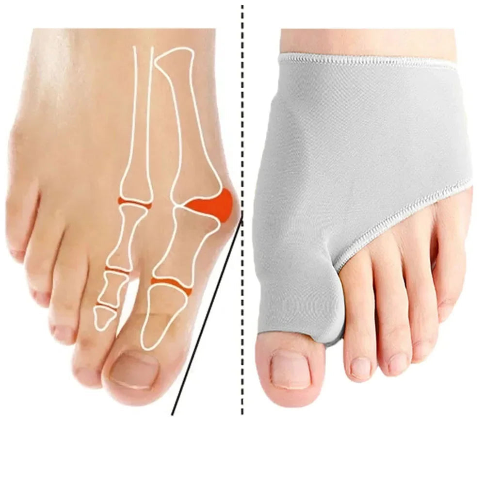 Schéma anatomique hallux valgus – articulation douloureuse avant et après port du correcteur – Ledoscare
